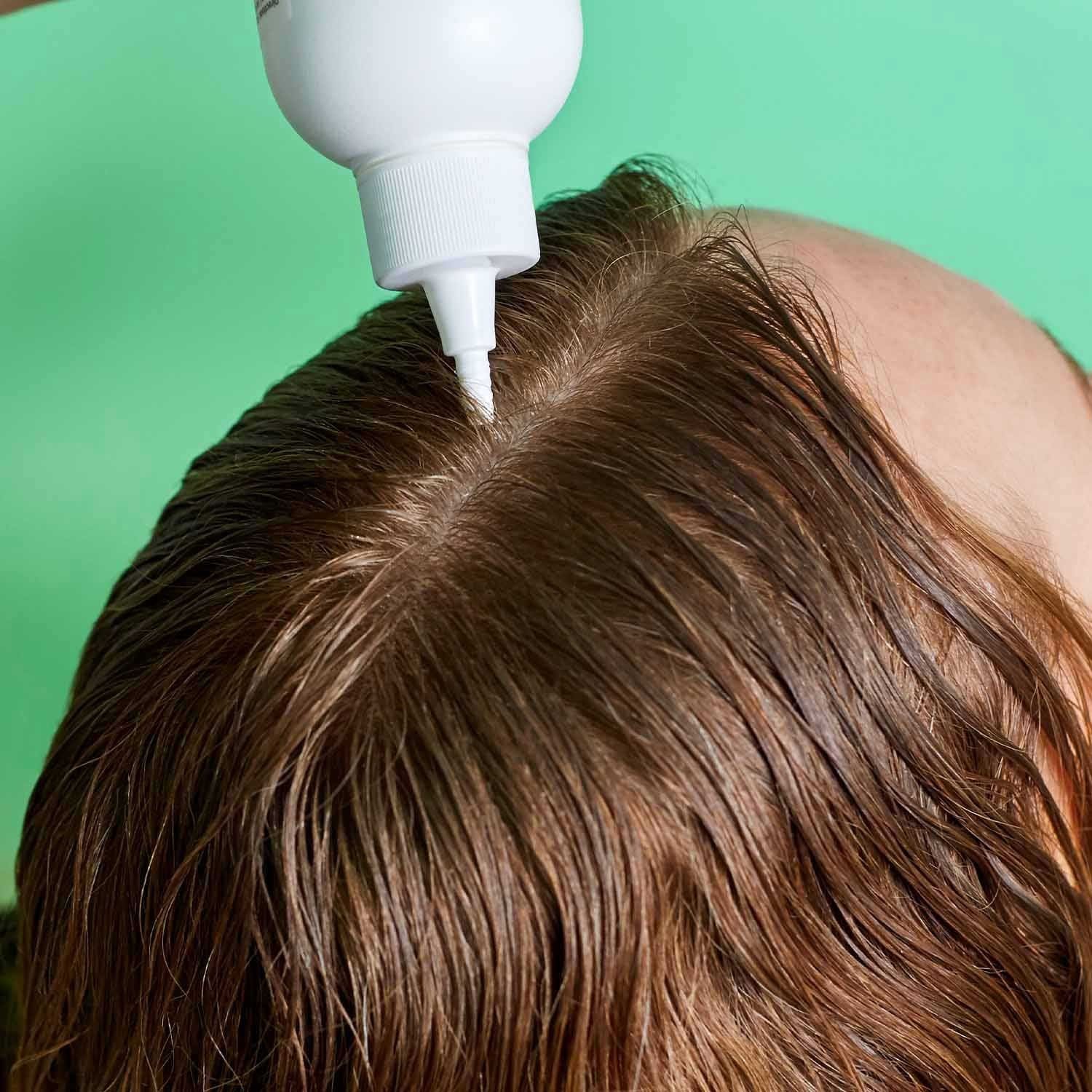 Flaky-Itchy Scalp Toner