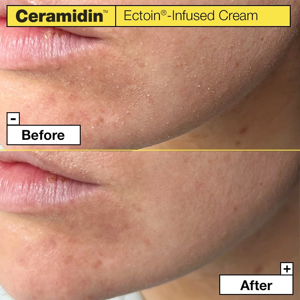 Ectoin-Infused Cream